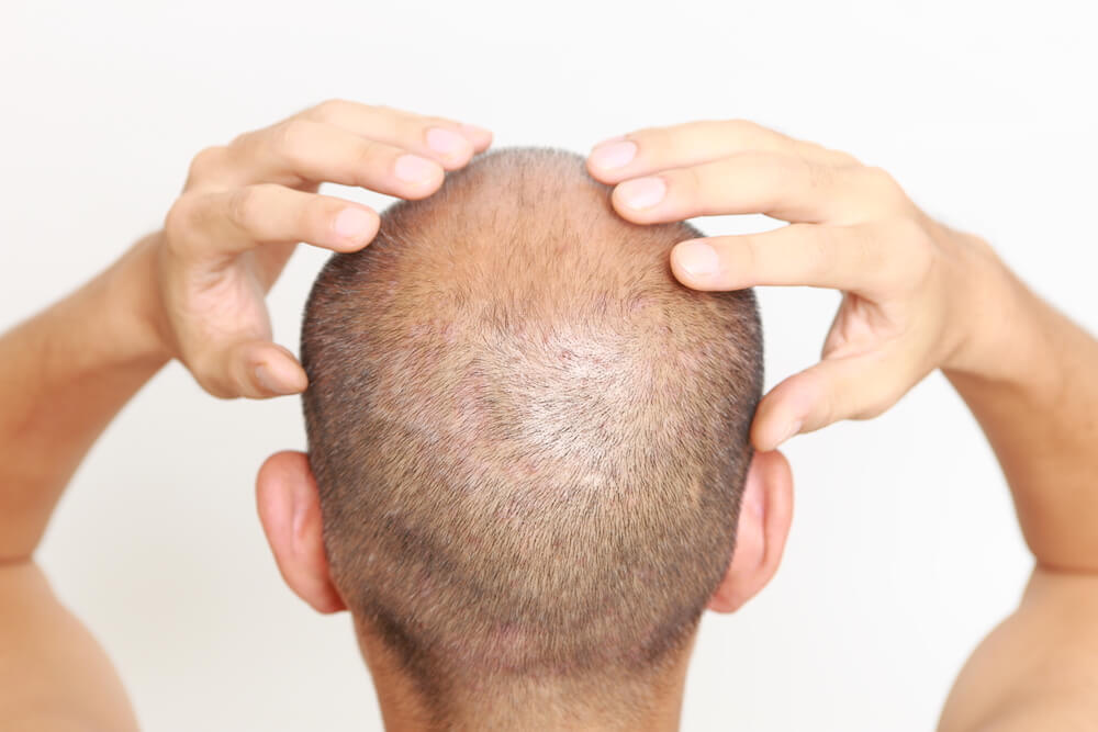 Hair Loss Treatment Near Me