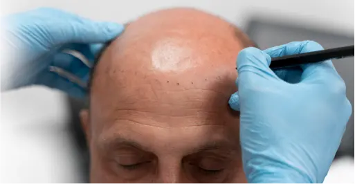 Benefits of Scalp Micropigmentation for Hair Loss