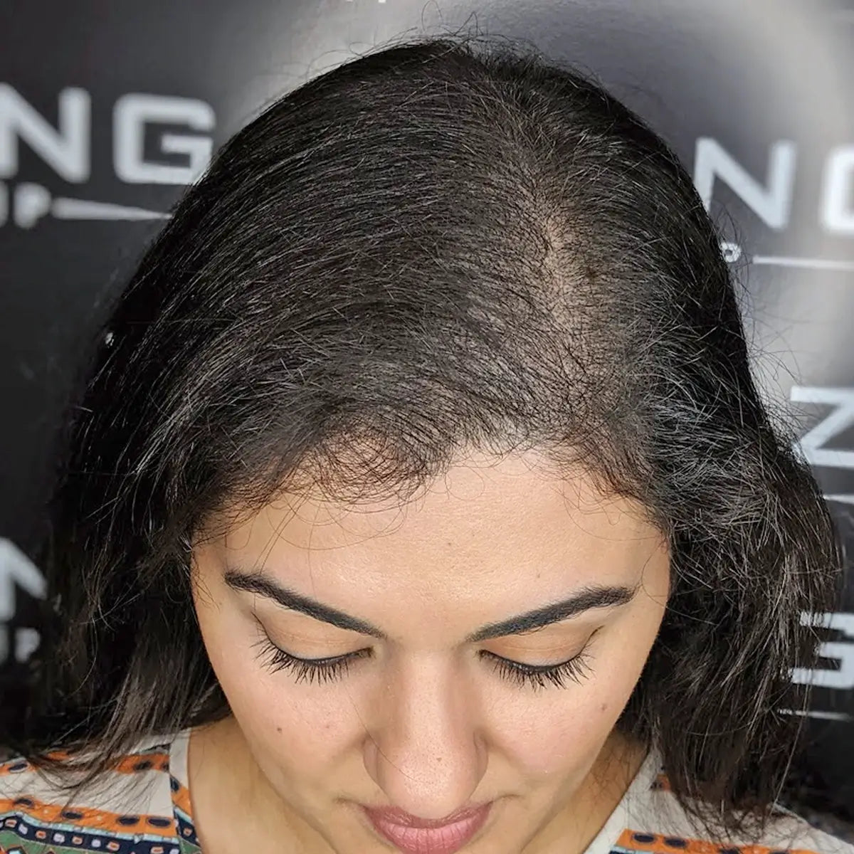Female Pattern Hair Loss Case Study Zang Smp