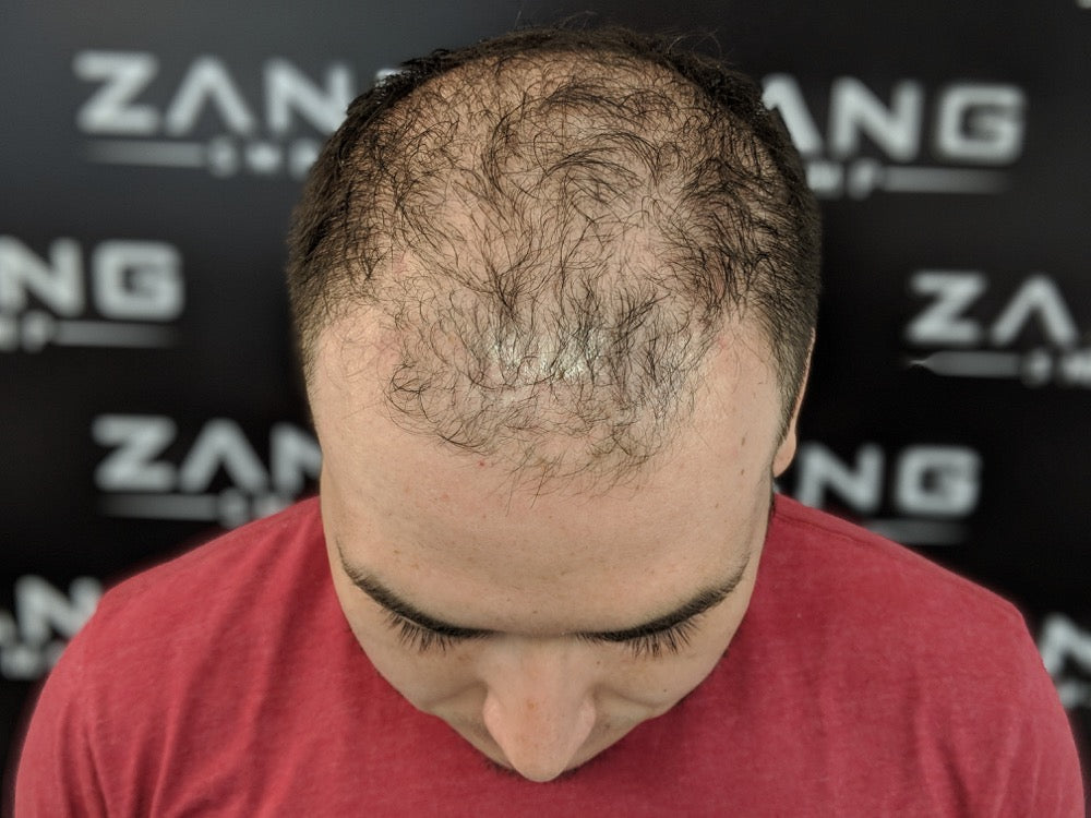 Gallery Smp Filler Treatment For Thinning Hair Zang Smp