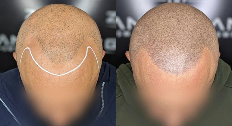 Key Differences Between SMP and Hair Plugs