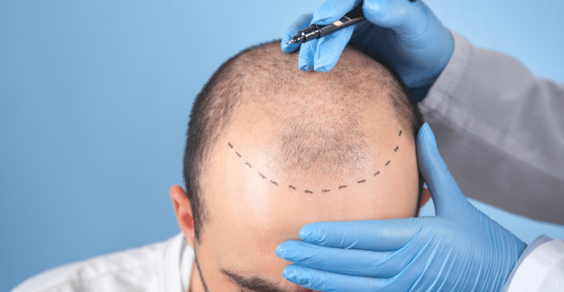 How Long Does Scalp Micropigmentation Take