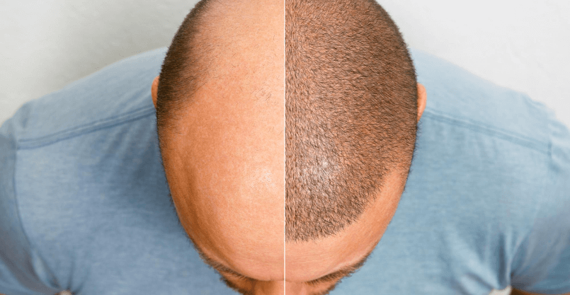 How Long Does Scalp Micropigmentation Take