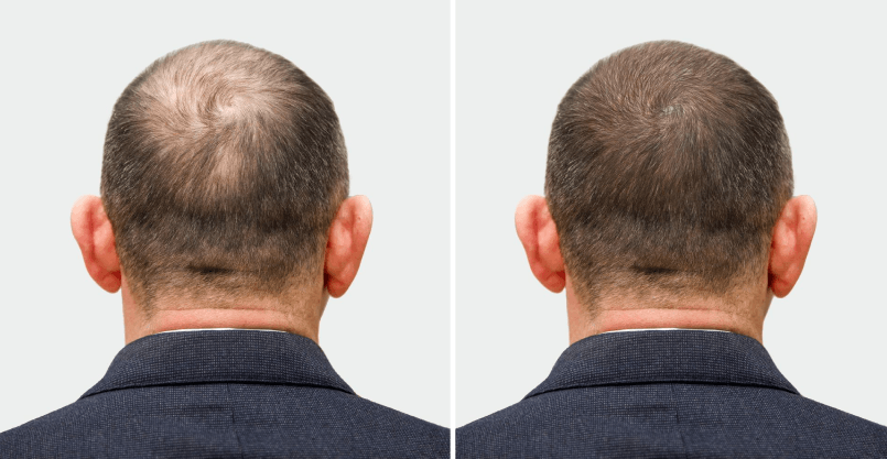 How Long Does Scalp Micropigmentation Take?
