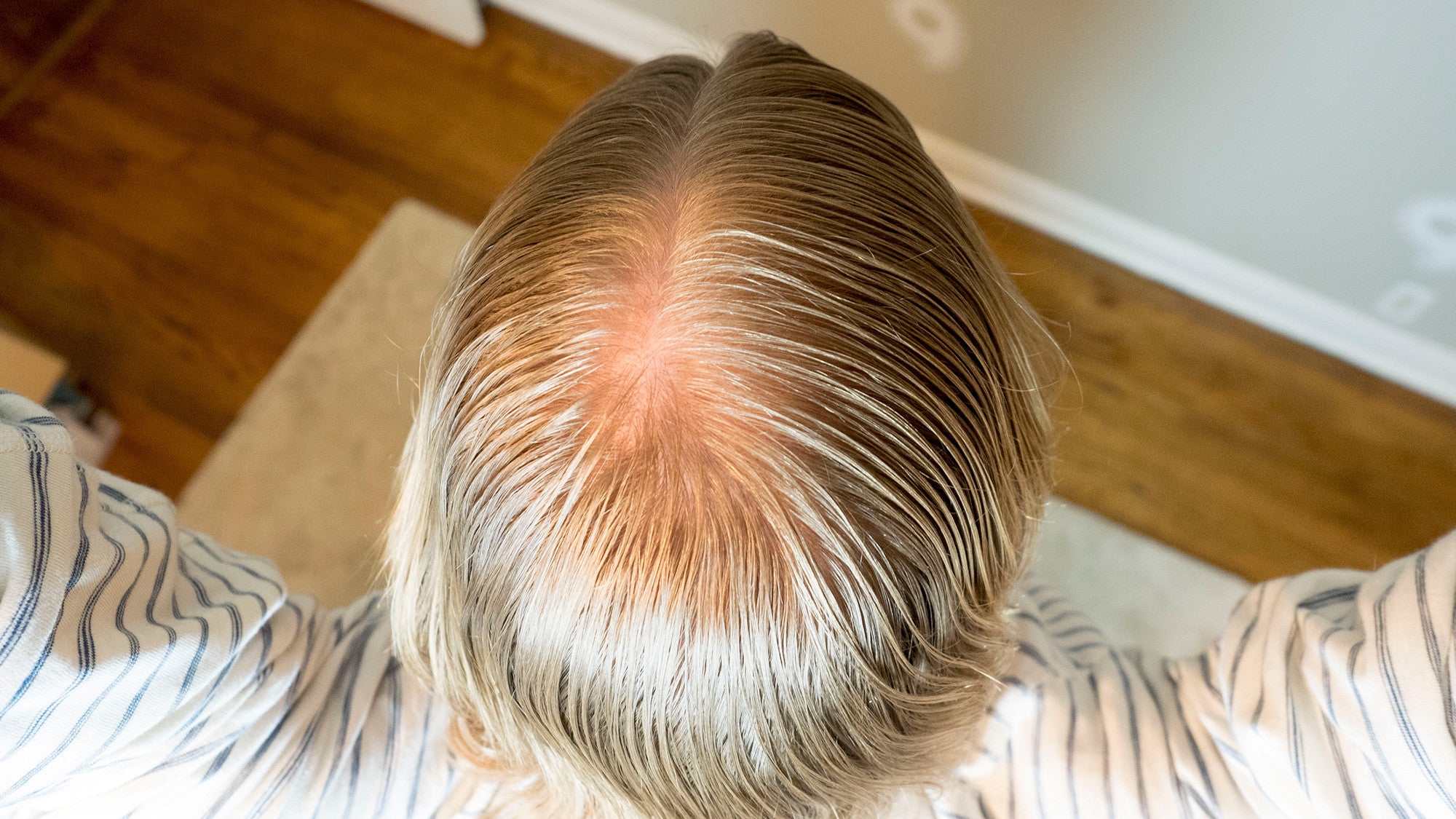 Male Head with Hair Loss Symptoms Front Side Stock Image  Image of head  isolated 43692873