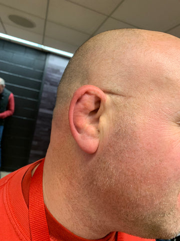 cauliflower ear