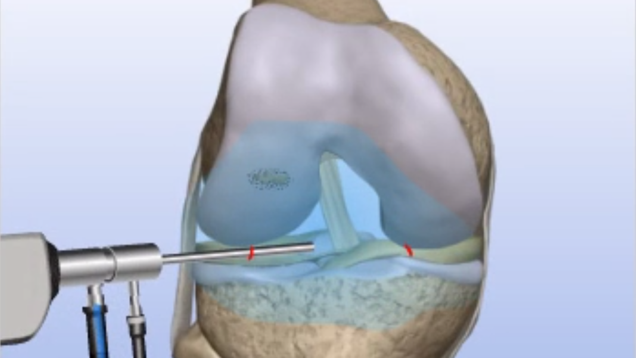 Cartilage Procedures