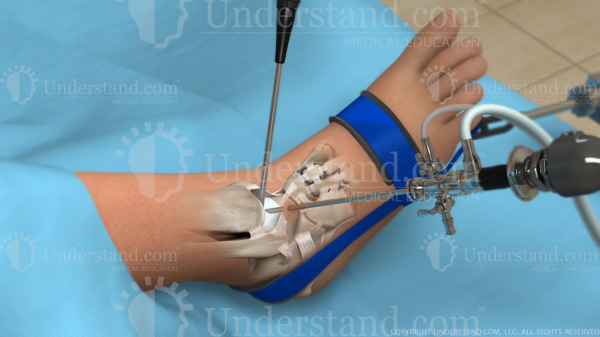 Ankle Arthroscopy Image