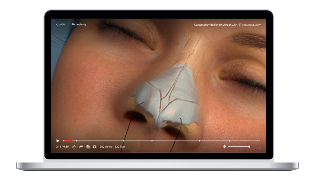 Nose Reshaping (Rhinoplasty) Animation – Understand.com