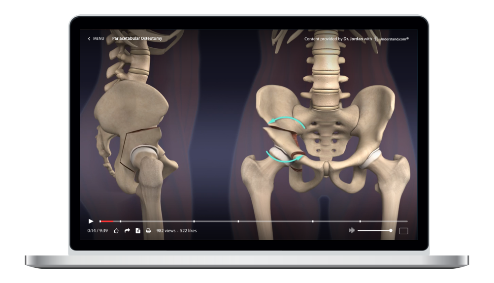 Periacetabular Osteotomy (PAO) Animation – Understand.com