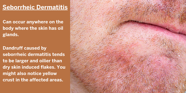 Beard Dandruff caused by seborrheic dermatitis tends to be larger and oilier than dry skin induced flakes