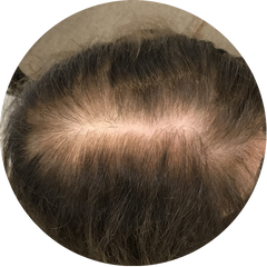 Image shows hair loss in a female