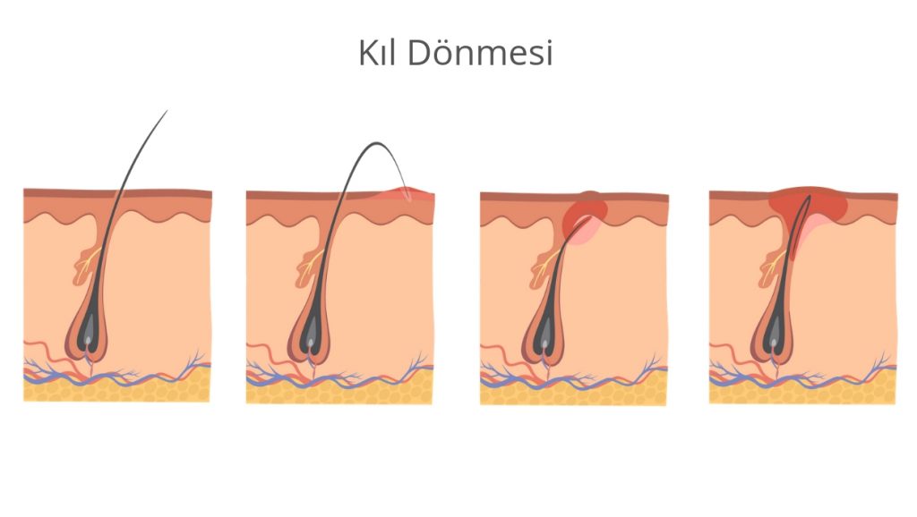 kıl dönmesi