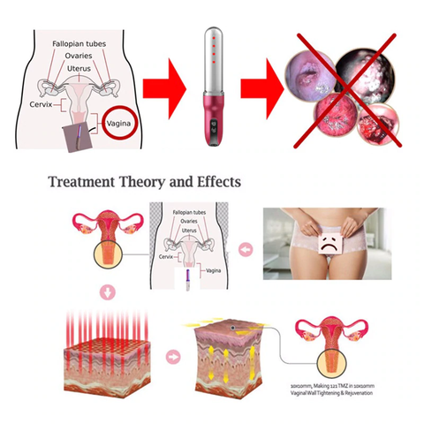 cold light laser for vaginal tightening and incontinence zenofsleep.com