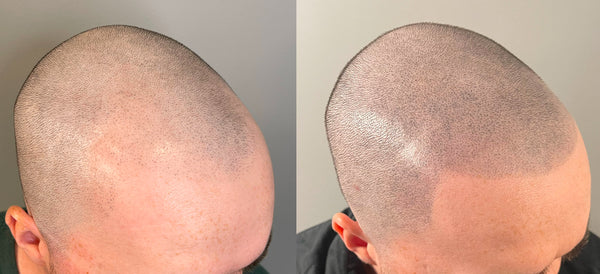 What is SMP? | Scalp Micropigmentation | Alison Jade