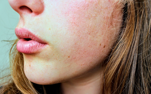 rosacea