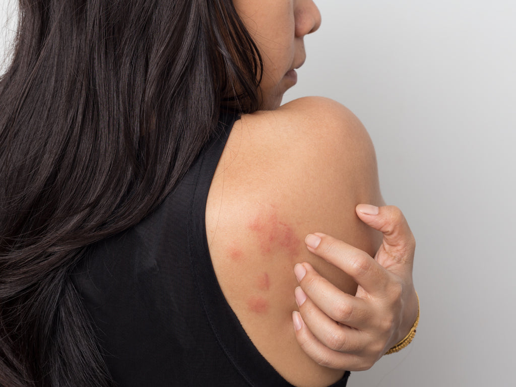 Stress Rash On Dark Skin