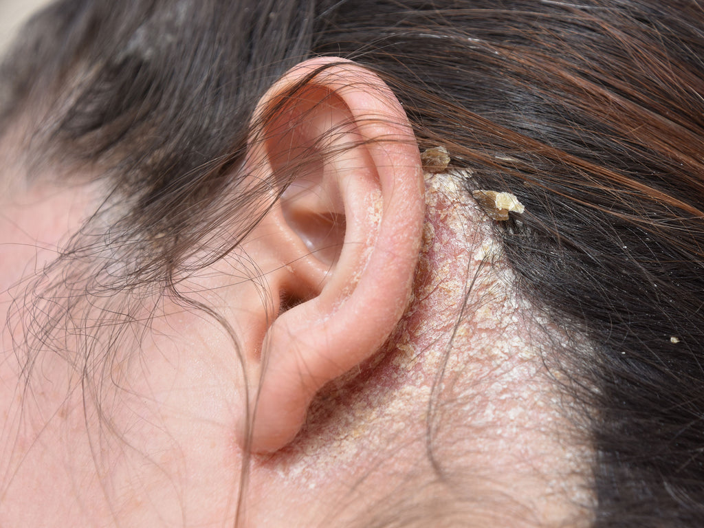 Woman experiencing scalp fungal infection