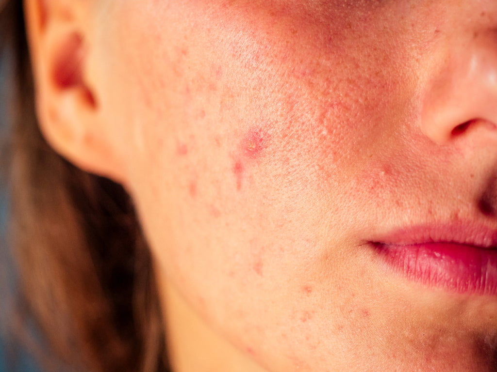 Nevada Rosacea Treatment