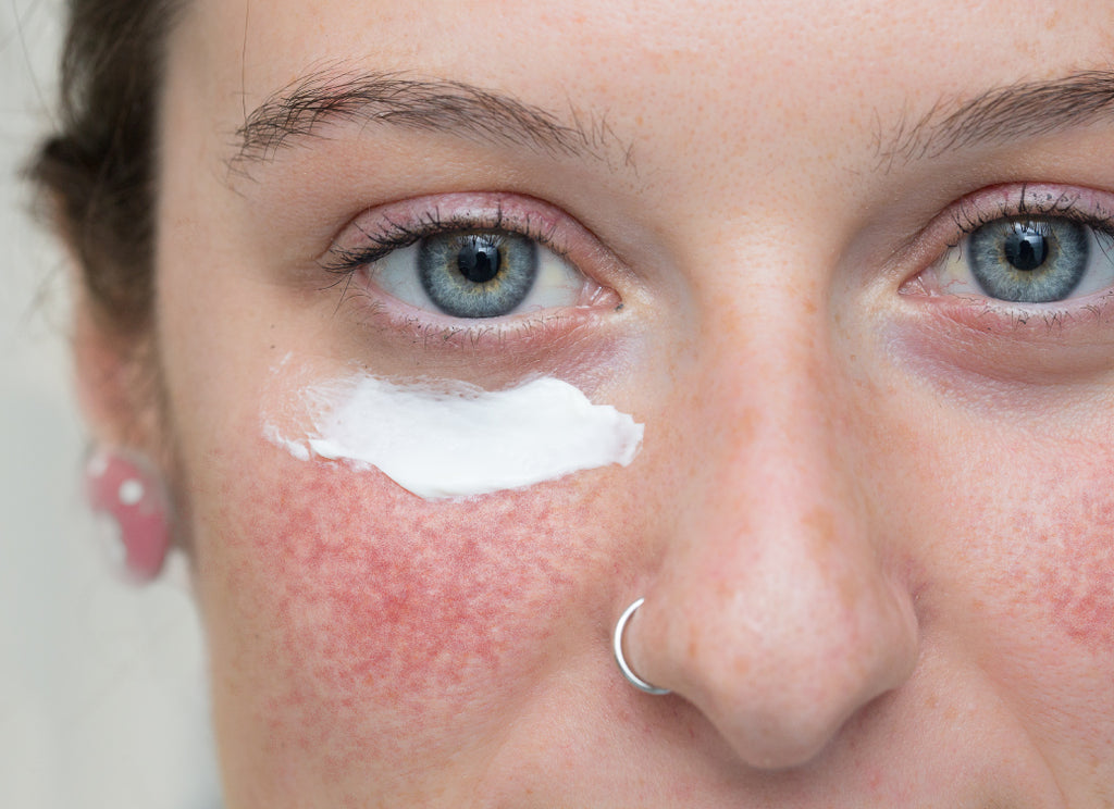 Does Rosacea Ever Go Away?