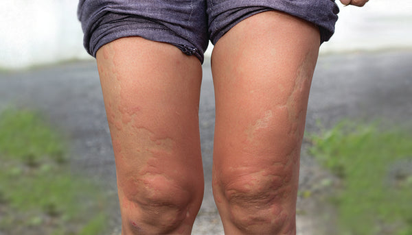 hives chlorine rash