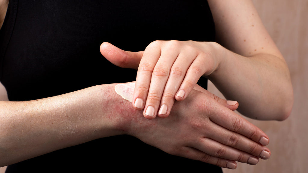 hand cream being used on sore dry hands