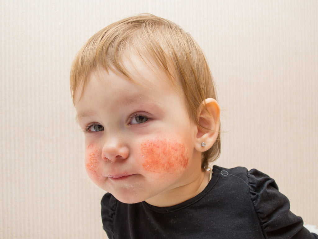 Best Natural Non-Sting Cream For Perioral Dermatitis In Toddlers