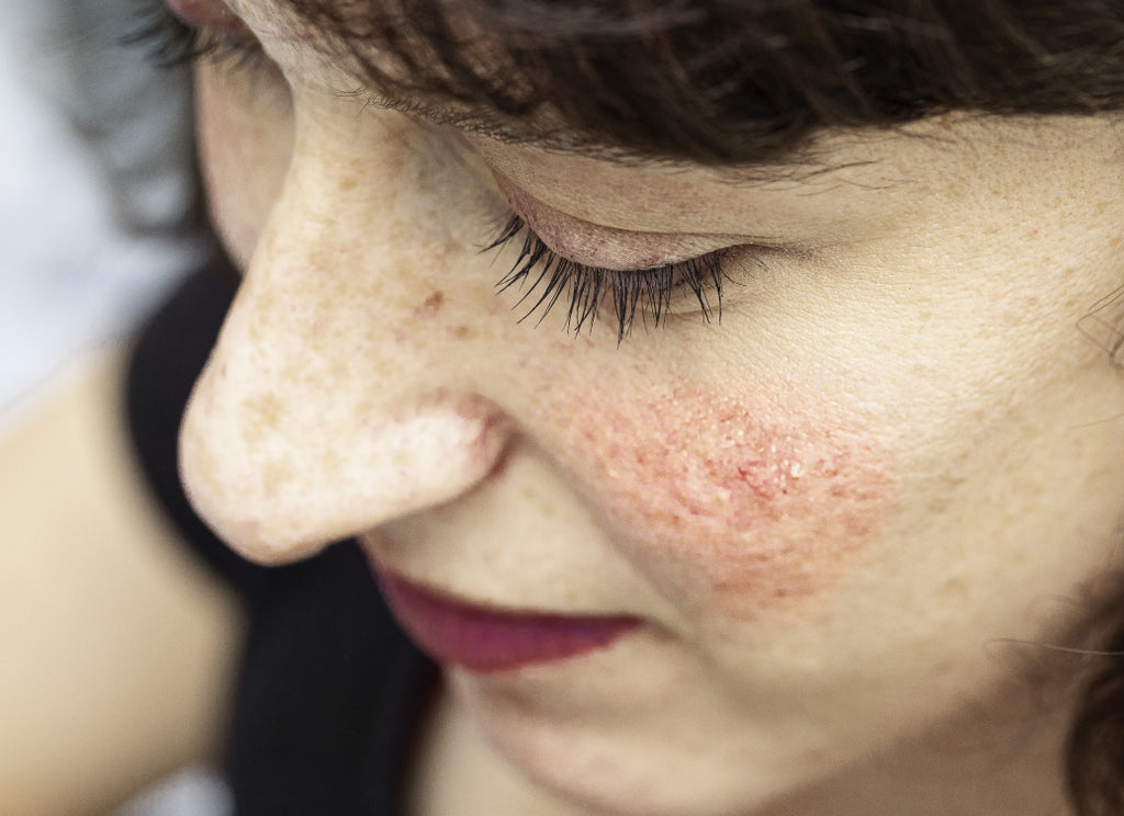 What Is The Main Cause Of Rosacea?