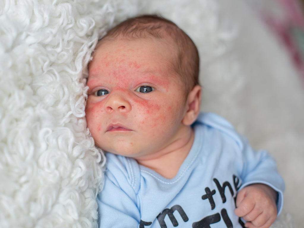 How to tell if your baby has eczema or acne