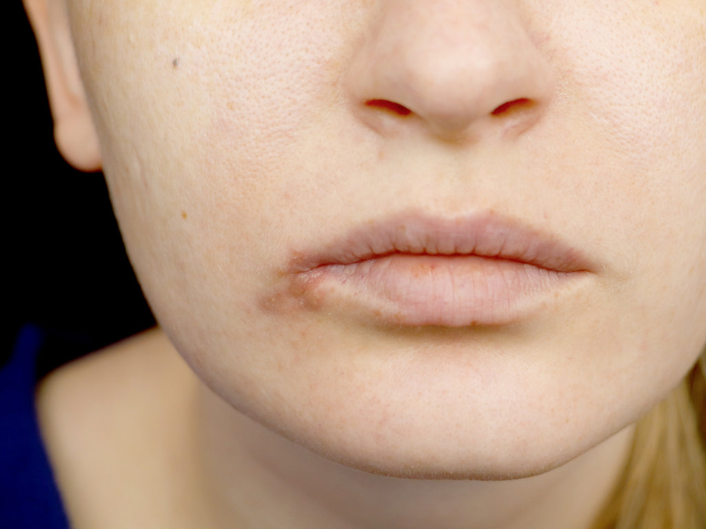 Is perioral dermatitis a fungal condition