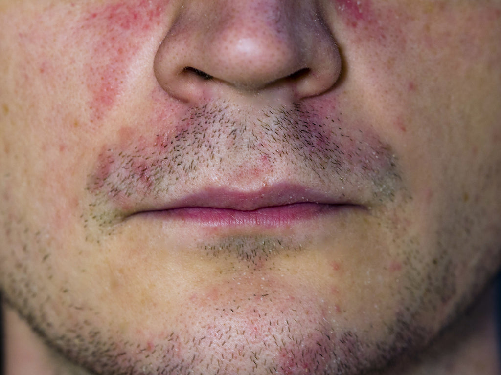 perioral dermatitis