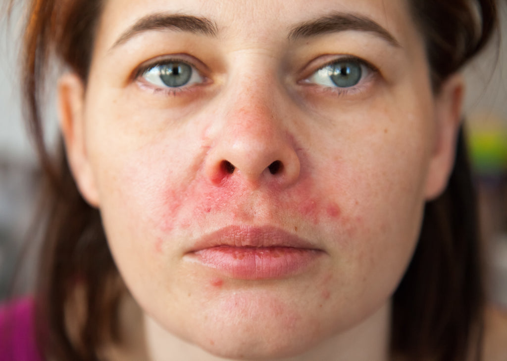 perioral dermatitis