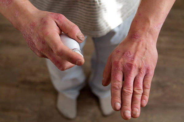 What Does Psoriasis Look Like?