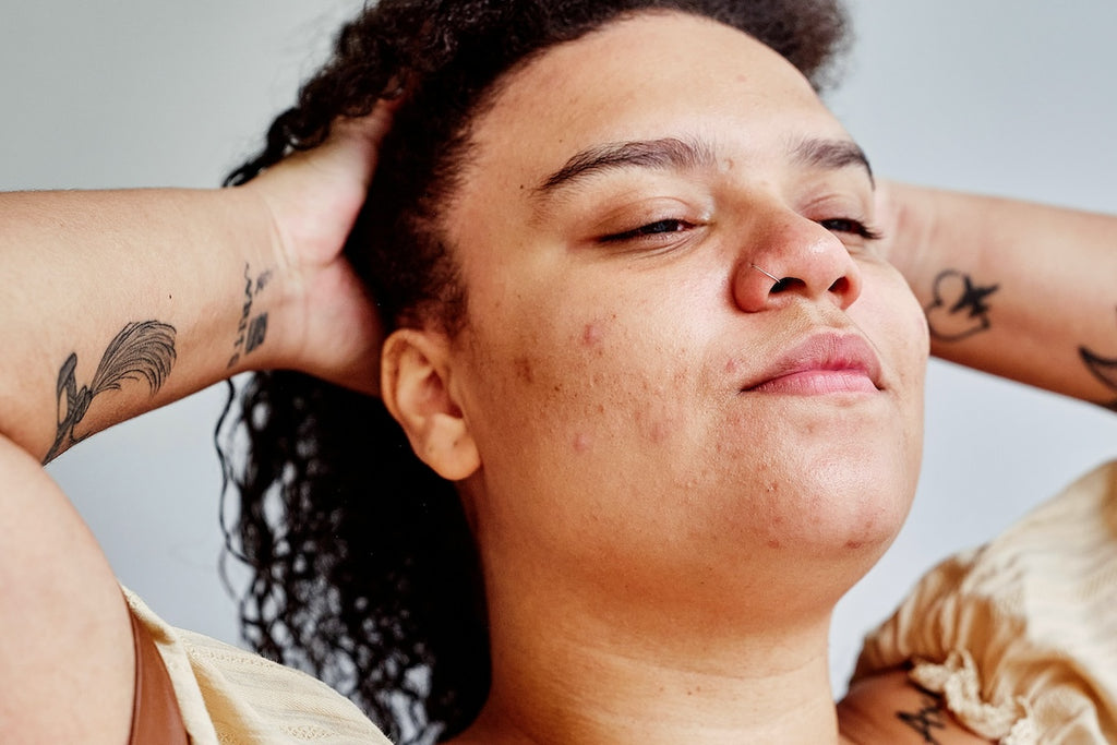 image of a woman showing real skin prone to stress reactions