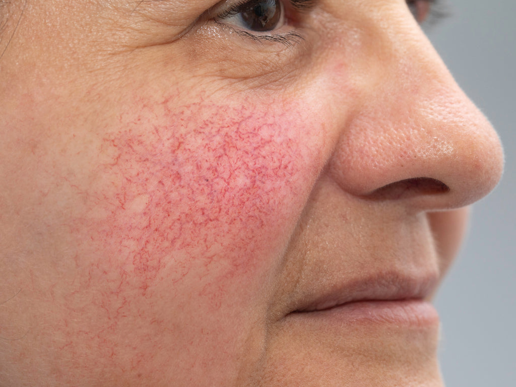 What Happens If Rosacea Is Left Untreated?