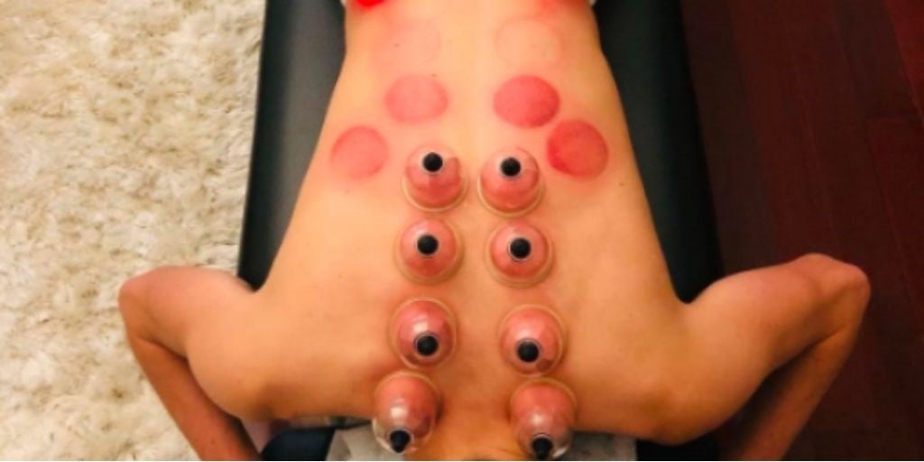 What do dark cupping marks indicate? How long do cupping marks last? –  Achedaway