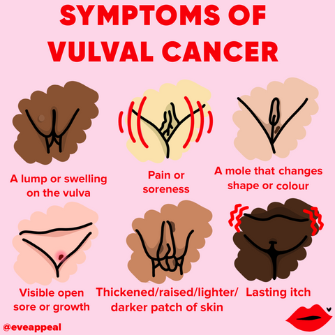 image depicting symptoms of vulva cancer 