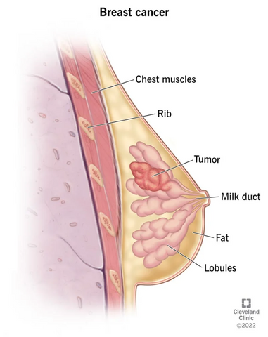 Breast cancer tumor development