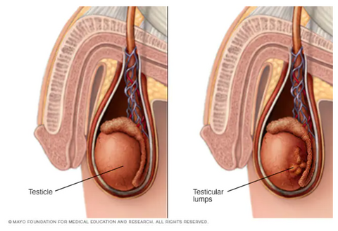 Testicular lumps