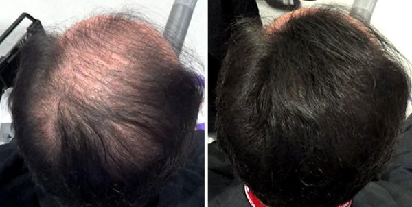 Volumon Hair Loss Building Fibres - KERATIN 28g 7