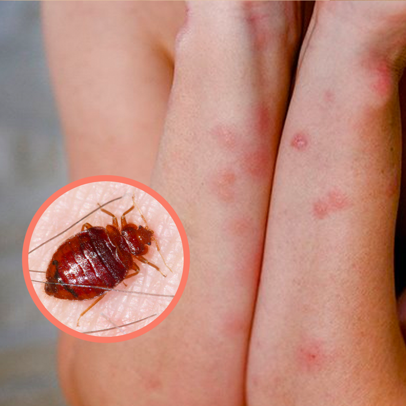 Tips To Prevent Bed Bug Bite Marks From Leaving Scars Bed Bug Sos 7305