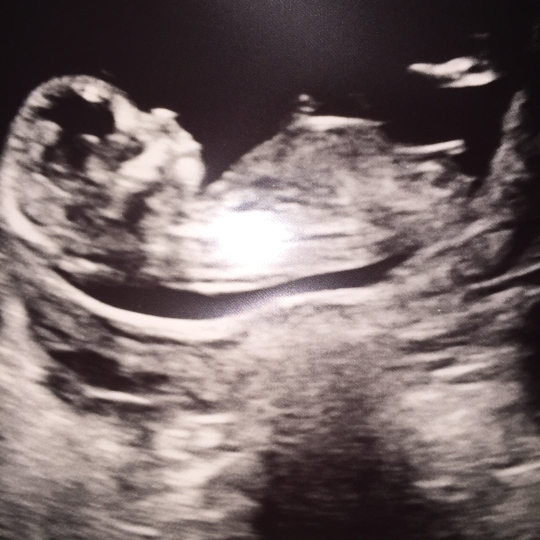 Confirmed Boy and Girl Ultrasound Scans - A Collection of Boy and Girl ...