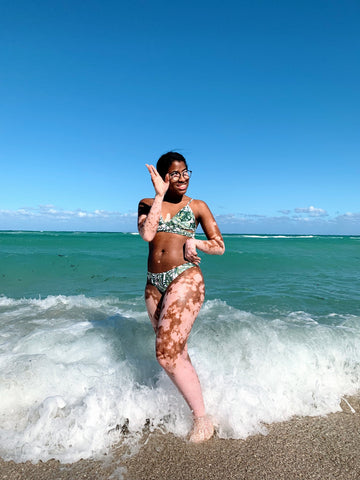 MIGA Blog- Mary at sea showing her vitiligo