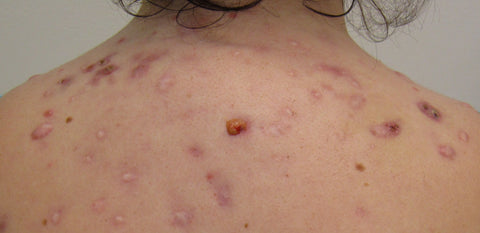 Acne on Woman's Back CBD Can Help