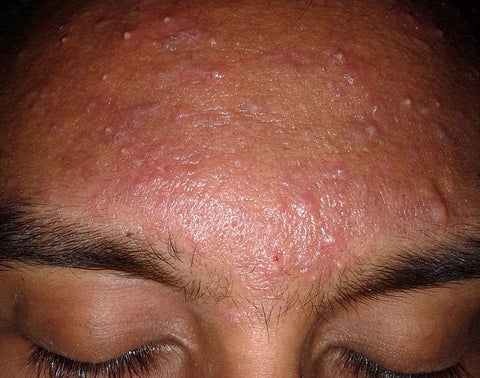 Facial Acne on Oily Skin CBD Natural Remedy