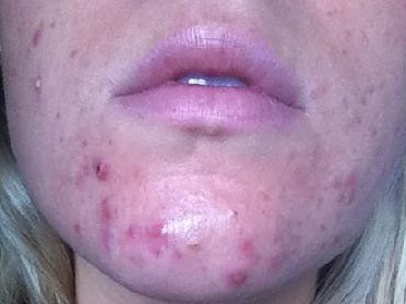 Acne Scars on Woman's Face CBD Can Help Naturally