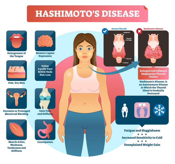 CBD for Hashimoto's thyroiditis infographic