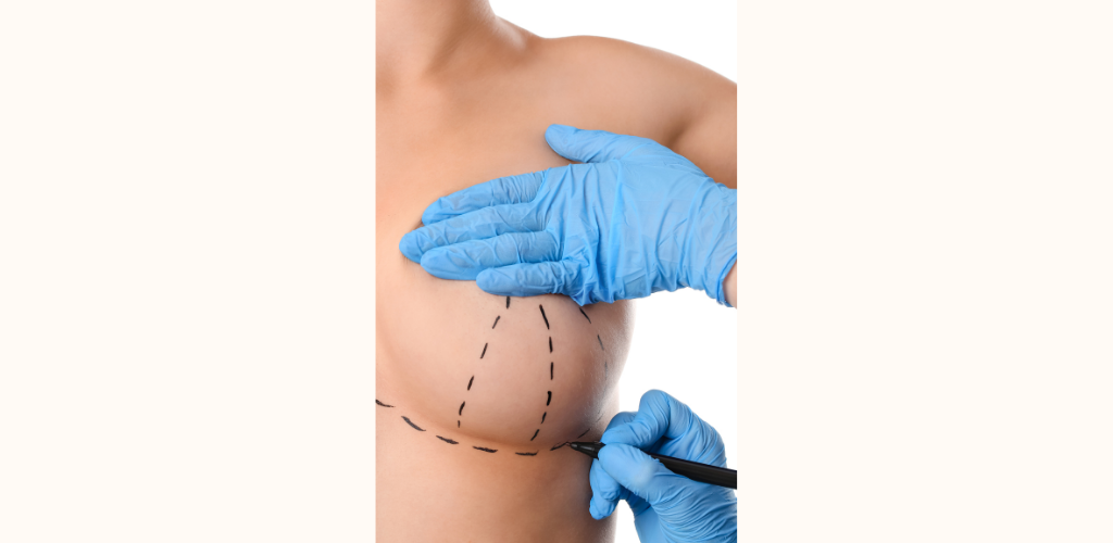 Breast Reduction Before and After: The Procedure, Insurance Coverage, and  Recovery