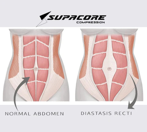 Abdominal Separation – Supacore