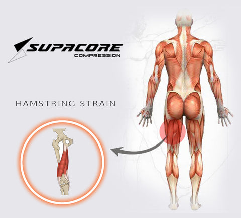 Hamstring Muscle Strain